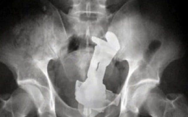 13 Random Objects That Don’t Belong Up Your Butt